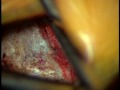 Video of L5-S1 Surgery Lumbar Microdiscectomy ...