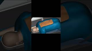 Download lagu Ini proses operasi tulang belakang #operasi #operasitulang #tipskesehatan #viral #tulangbelakang mp3