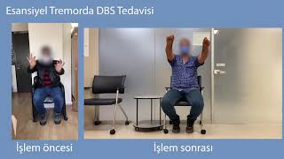 Esansiyel Tremorda DBS Tedavisi - Prof. Dr. Selçuk Peker