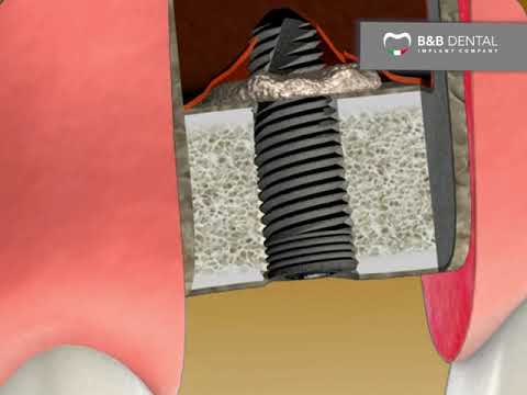 B&B Dental | transcrestal sinus lift protocol - sinus lift kit