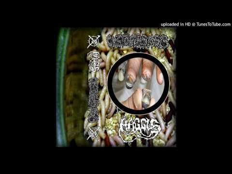 Cystoblastosis - Surgical Revision For Stump