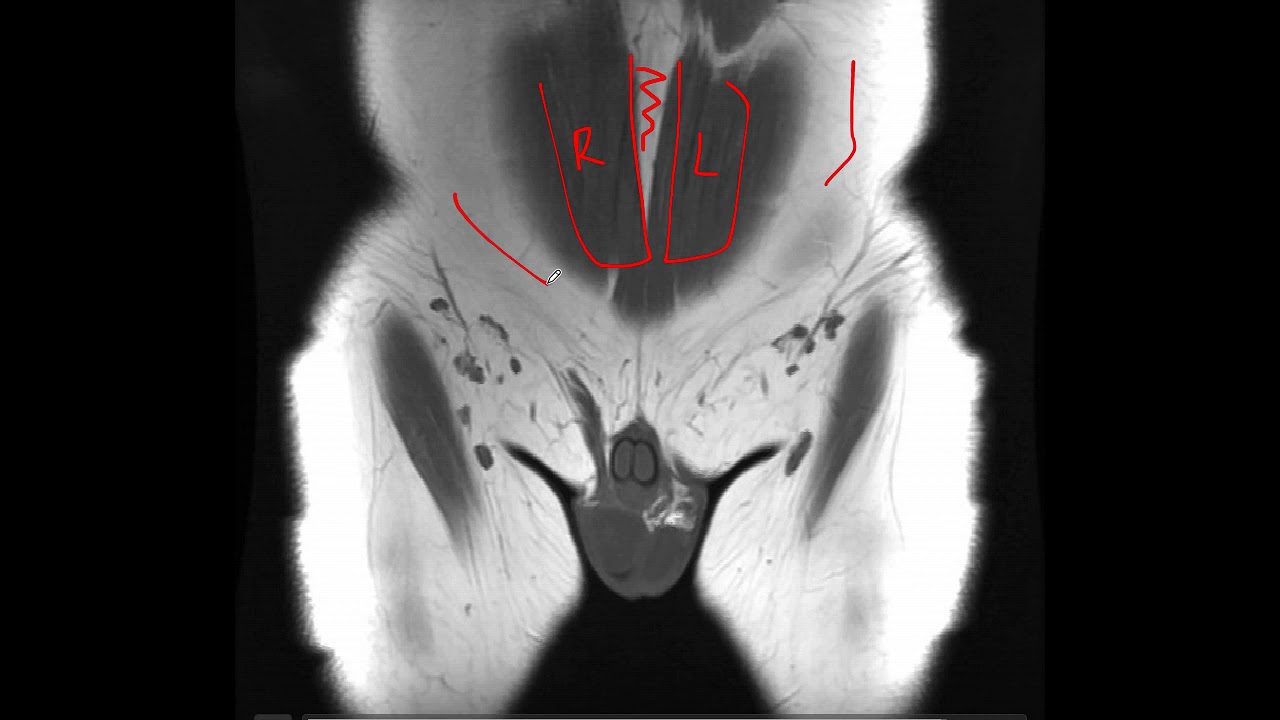 Anatomia RM pelvis y caderas