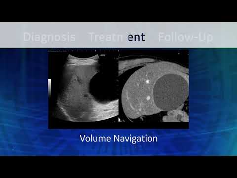 LOGIQ E10 Series Ultrasound: Liver Care Continuum