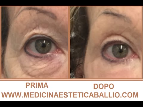 Come rimuovere borse hernial da sotto di occhi È possibile aggiungere la vitamina A ed e per affrontare pacchi