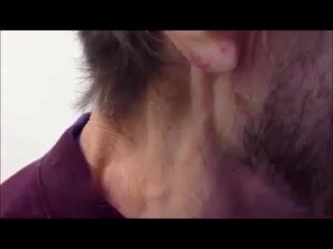 Jugular Veins Distention - JVD -Neck veins Valsalva  | The Virtual Nephrologist | Dr. Rifai