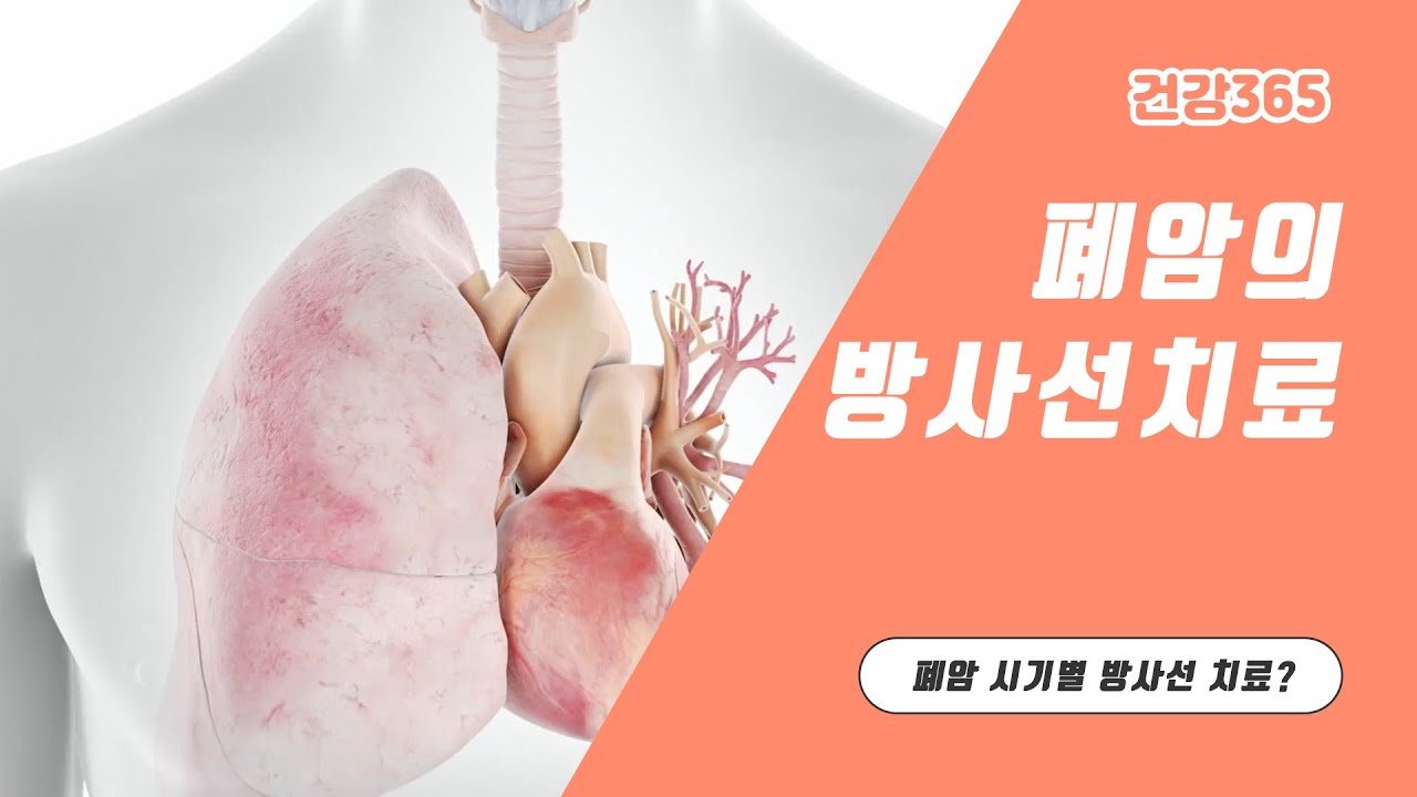 폐암의 방사선 치료 | 방사선종양학과 박승규 교수 관련사진