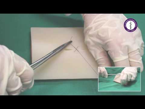 Sutura em "X" ou Cruzado (Sultan)