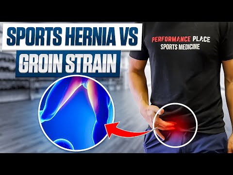 Sports Hernia vs. Groin Strain: Unraveling the Differences
