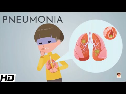 Pneumonia: Everything You Need To Know