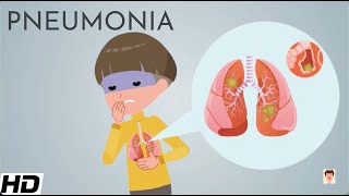 Pneumonia: Everything You Need To Know
