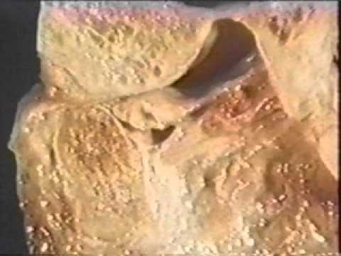 Spray cinesi articolazioni Sviluppo del gomito dopo lictus