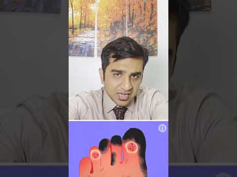 What is Gangrene? | What is Gangrene