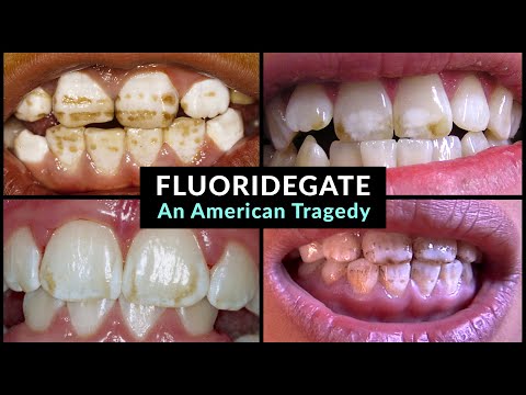 Fluoridegate: An American Tragedy