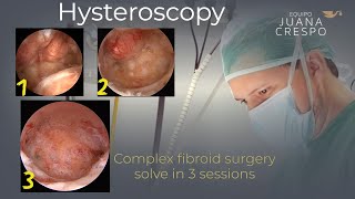 Fibroid surgery solved in 3 sessions