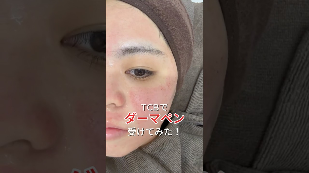 大学生がダーマペン受けてみた！