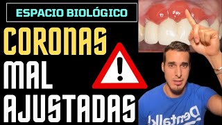 Así le quedaron las ENCÍAS por unas CORONAS mal ajustadas - ESPACIO BIOLÓGICO PERIODONTAL