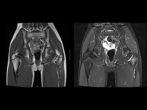 Osteoid Osteoma | MRI Scan, 3T Siemens MRI