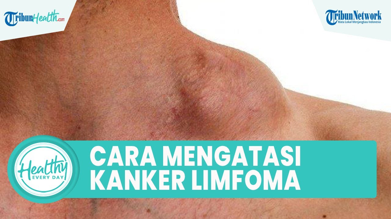 Kanker Limfoma Dapat Akibatkan Pembengkakan Kelenjar Getah Bening