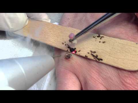 comment soigner spina bifida