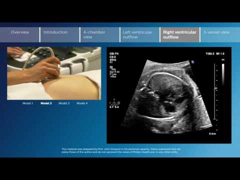 Key screening views of the fetal heart - Part 5 - Right ventricular outflow