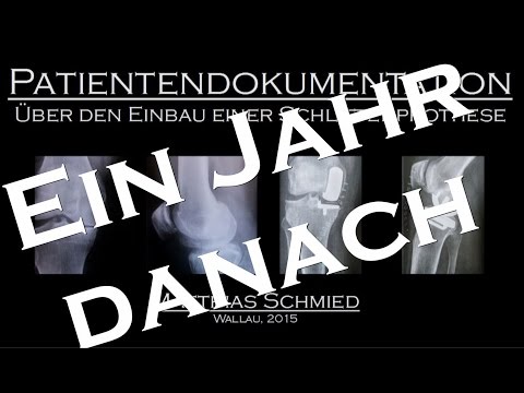 Standard-Behandlung der zervikalen degenerativen Bandscheibenerkrankungen Schmerzen in der Wirbelsäule in den unteren Rücken Bögen