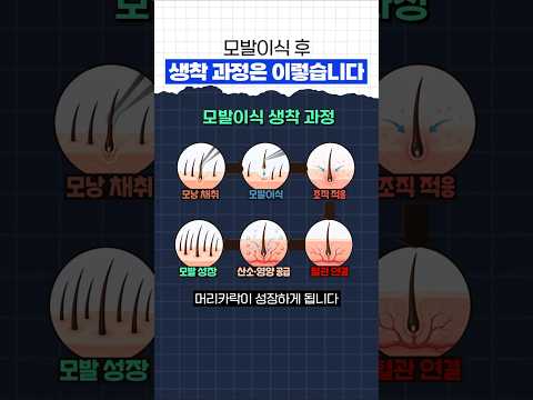 모발이식 후 생착 과정은 이렇습니다 #모모의원 #강동우대표원장