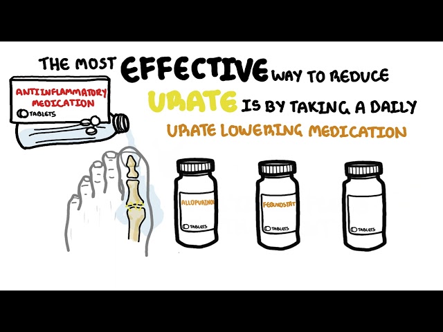Gout treatment overview