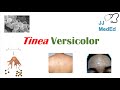 “Fungal Skin Infection of Many Colors” (Tinea Versicolor) | Pathogenesis, Symptoms and Treatment