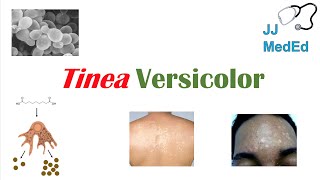 “Fungal Skin Infection of Many Colors” (Tinea Versicolor) | Pathogenesis, Symptoms and Treatment