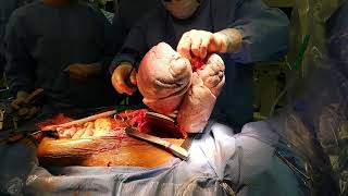 Removal of Lungs from Brain Dead Donor for Transplant