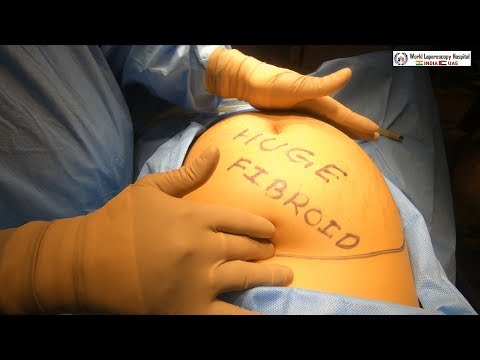 La première au monde resection de 3,5 kg d'un fibrome, d'un kyste ovarien, d'une vésicule biliaire et d'un appendice par laparoscopie