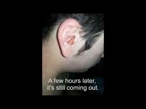 Worst Ear Infection Ever! Must See!