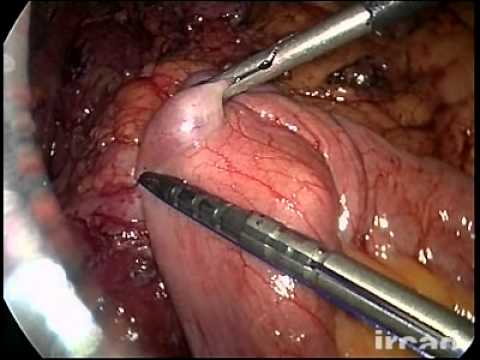 Robot-assisted Conversion from Nissen Fundoplication to Gastric Bypass