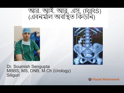 আর. আই. আর. এস. (RIRS)-- Ectopic Malrotated kidney Stone--এবনর্মাল অবস্থিত কিডনিতে পাথর।