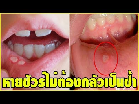 รักษากลากยาย Psorilom คิดเห็นโรคสะเก็ดเงิน tar แชมพู