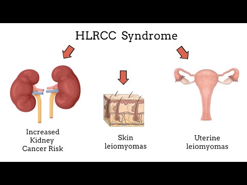 Hereditary Leiomyomatosis and Renal Cell Cancer (HLRCC) - Overview of genetic kidney cancer syndrome