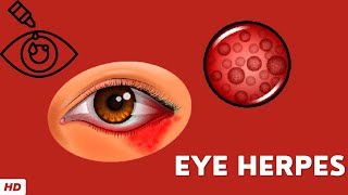 Eye Herpes, Causes, Signs and Symptoms, Diagnosis and Treatment.