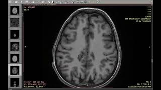1-Multi-nodular and vacuolating tumor of the cerebrum