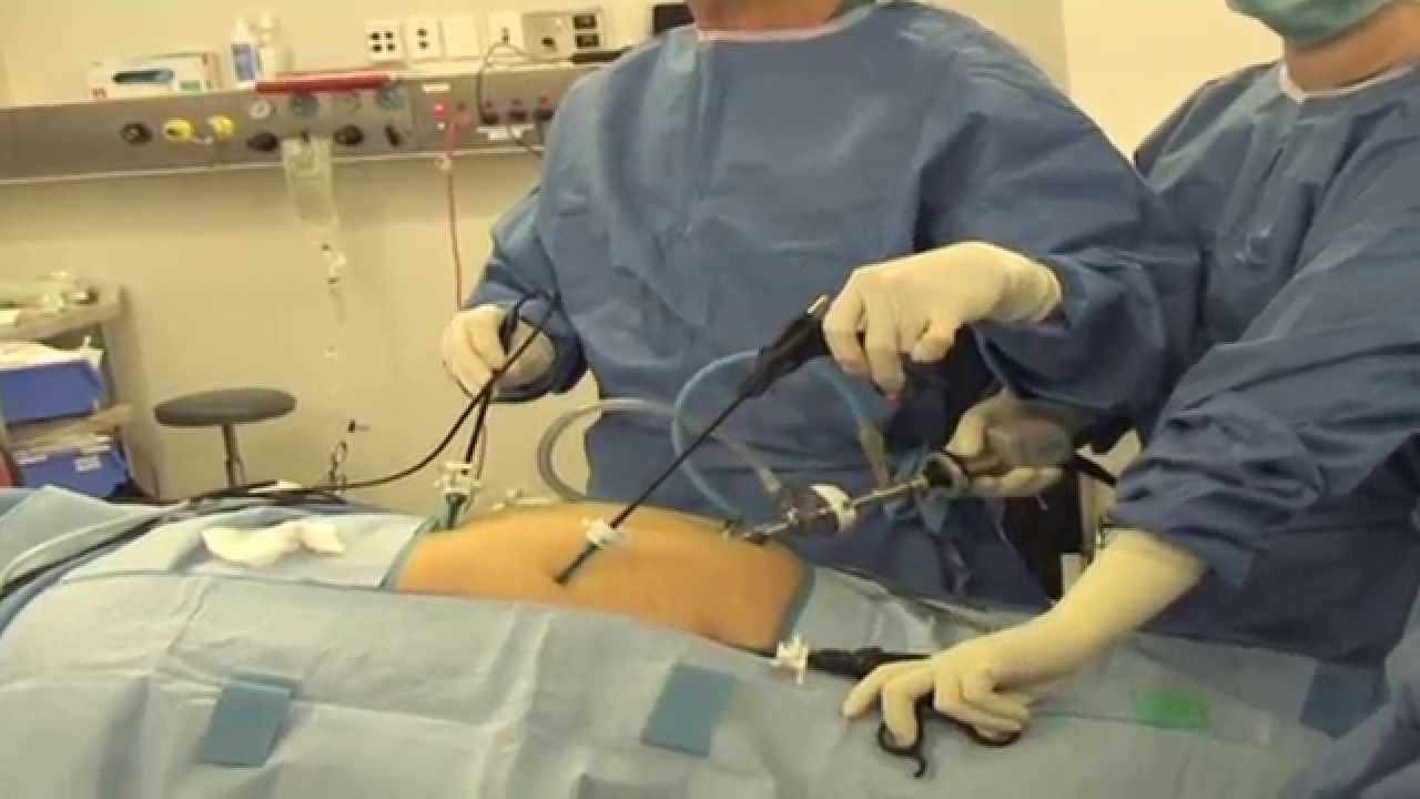 Laparoscopic Cholecystectomy