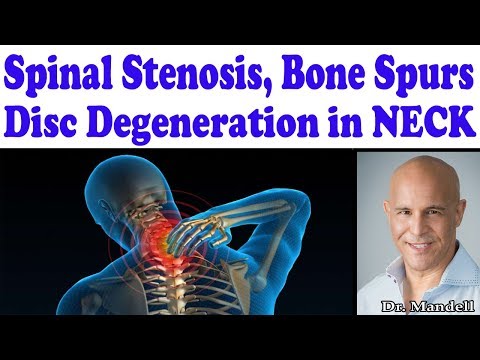 Best Strategies for Cervical (Neck) Spinal Stenosis, Disc Degeneration, Bone Spurs - Dr Mandell, DC