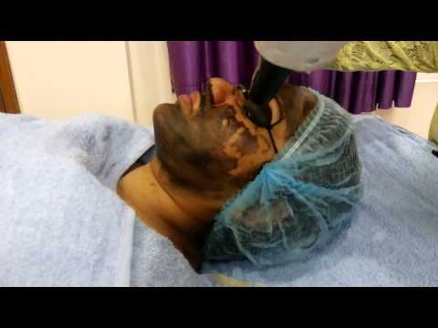 Skin Rejuvenation with Q switched ND YAG laser at Riyaanz Aesthetic