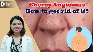RED DOTS ON SKIN | Cherry Angioma & its Treatment | Red Moles - Dr. Amee Daxini | Doctors