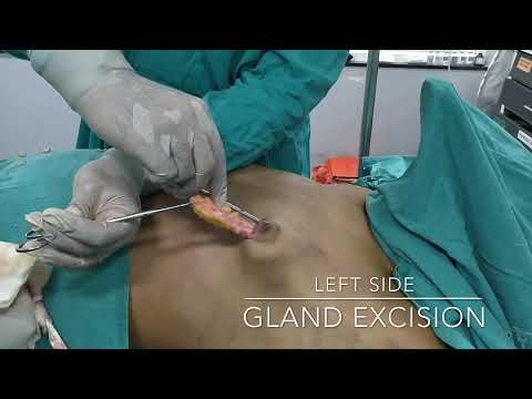 Puffy Nipple Gland Excision Review
