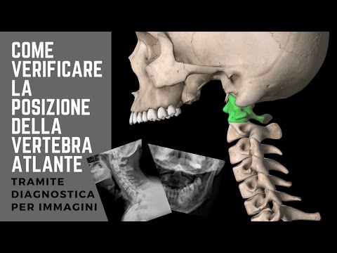 Iniezioni o compresse da antidolorifici osteoartrite Lacrima degenerativa del corpo e del corno posteriore del menisco mediale del ginocchio
