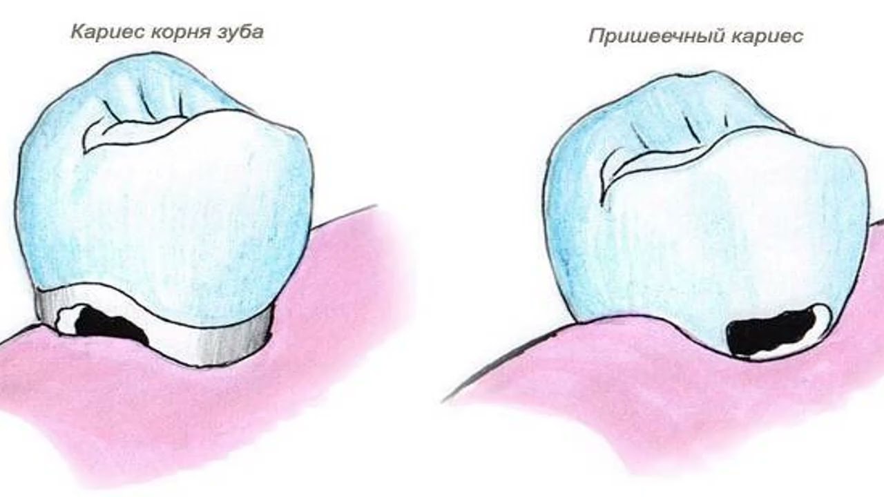 Karies haqida tushuncha. Karies kovaklari tasnifi