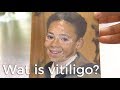 Wat is vitiligo?  | Vragen van kinderen | Het Klokhuis