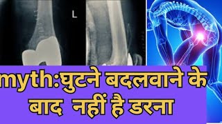 क्या घुटना बदलवाना सही है या नहीं ||myth about is knee replacement surgery is not good. watch full