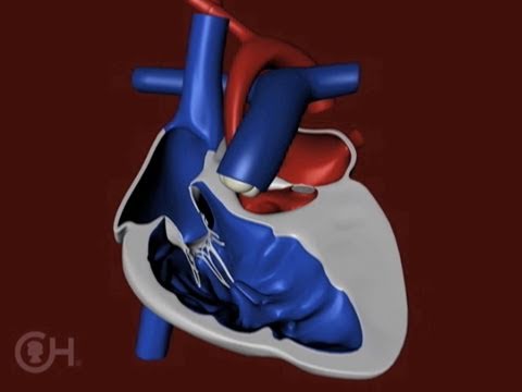 Hypoplastic Left Heart Syndrome (HLHS) | Children's Hospital of Philadelphia