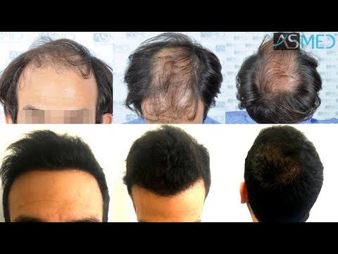 Manual FUE Hair Transplant Before & After, 5544 Grafts Result - ASMED - Dr. Koray Erdogan