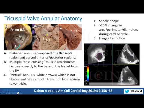 Novel Concepts of Tricuspid Regurgitation: Anatomy, Pathophysiology and Management